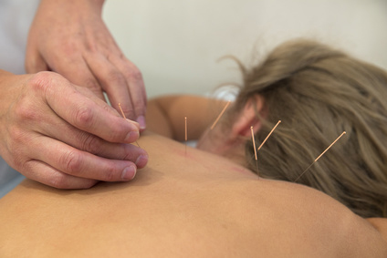 Acupuncture acupuncture